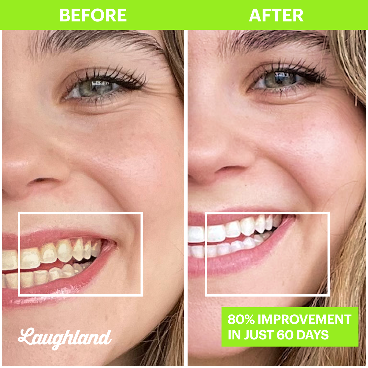 Laughland™️ Teeth Whitening Kit Made By Dentists Laughland Sciences