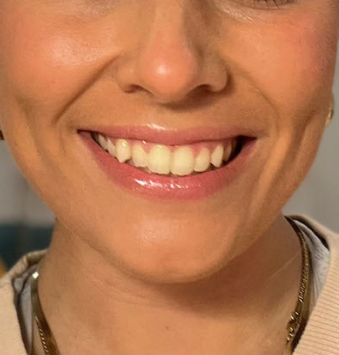 ⚡️ At-Home Whitening Kit ⚡️